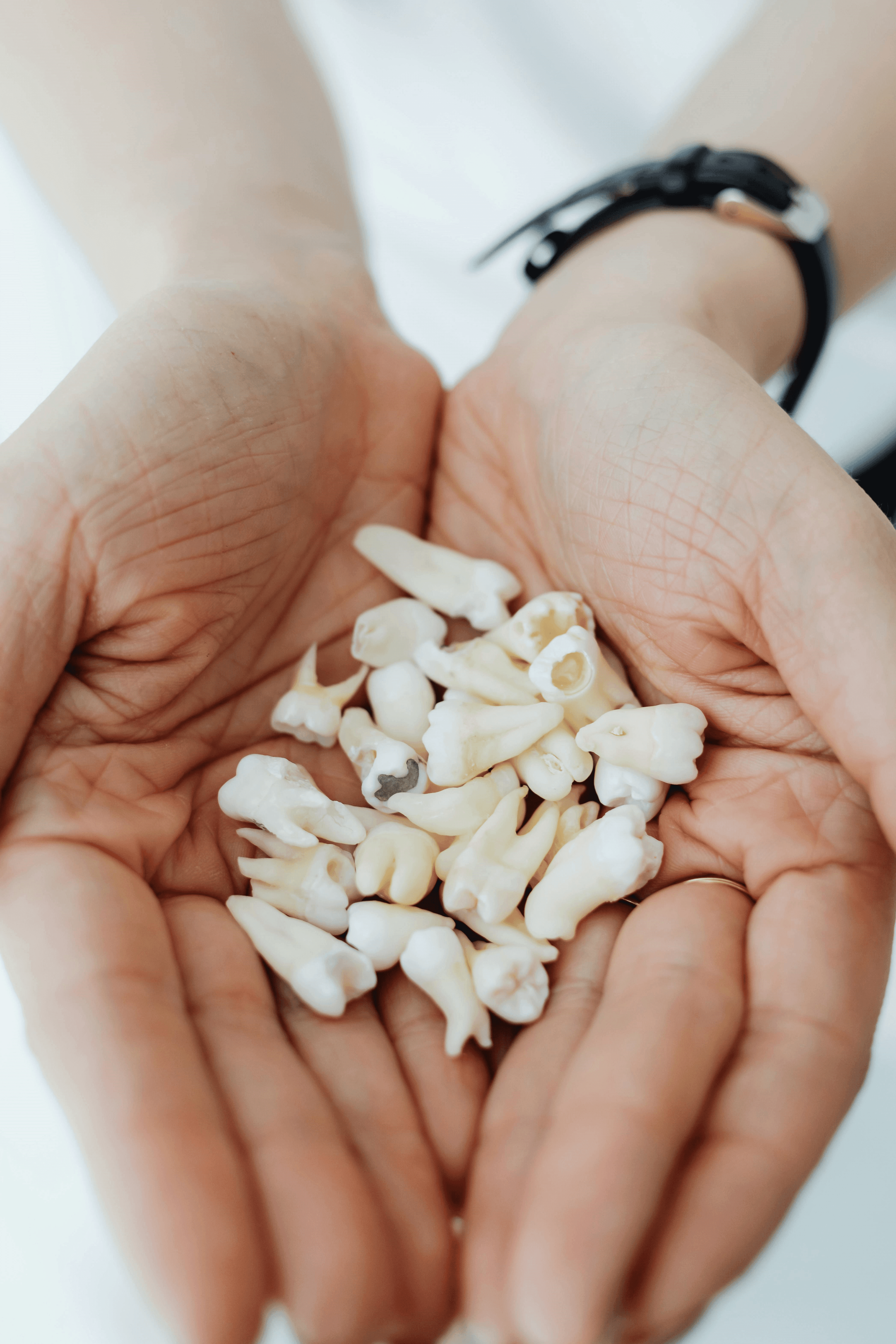 Hands showing extracted teeth with tooth decay.